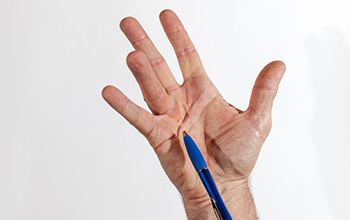 Nonsurgical Treatment for Dupuytren’s Contracture